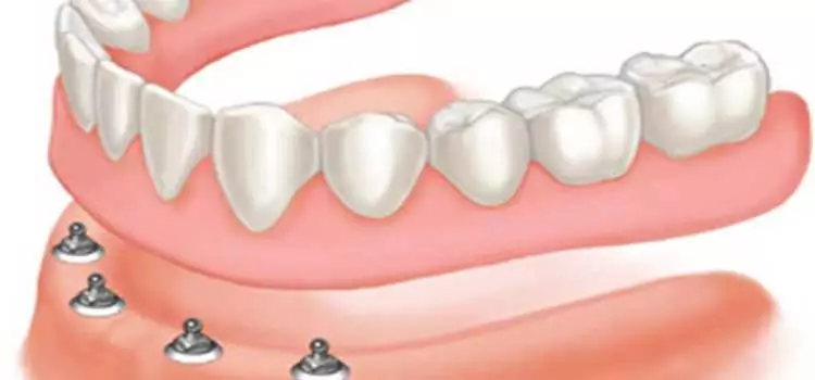 Overdenture: Procedimento para a inserção de dois elementos